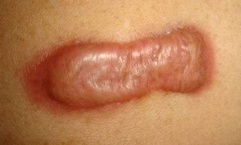 Keloid Scars